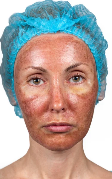 Punti neri su una gelatina di faccia