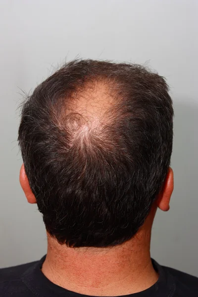 Male head with hair loss symptoms back side