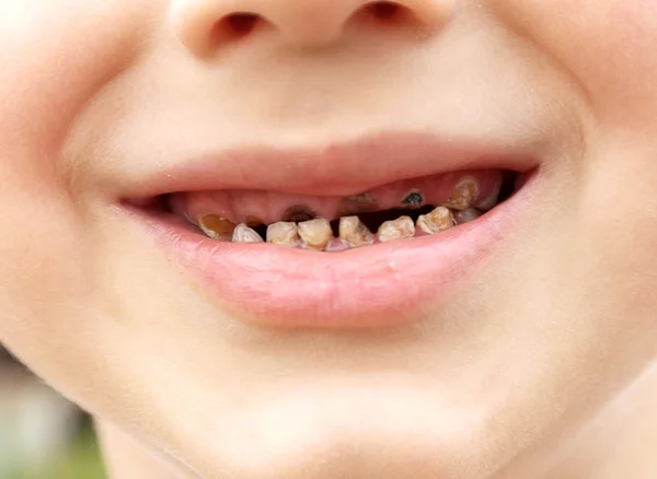 Calf&#039;s Teeth decay Toothache Dental Medicine
