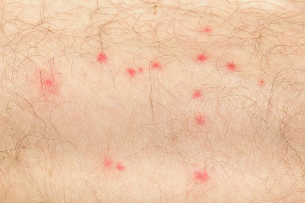 Mosquito spots on human skin