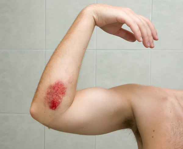 Scraped elbow - the result of inline skating accident