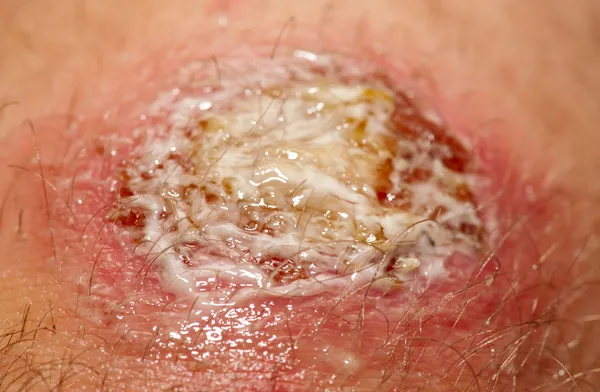 Wound covered with antibacterial gel