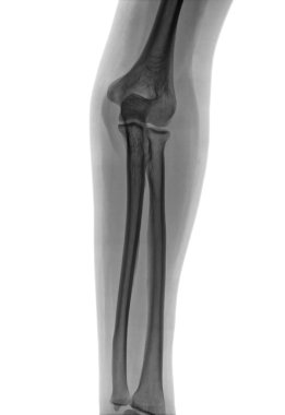 Elbow X-ray negative clipart