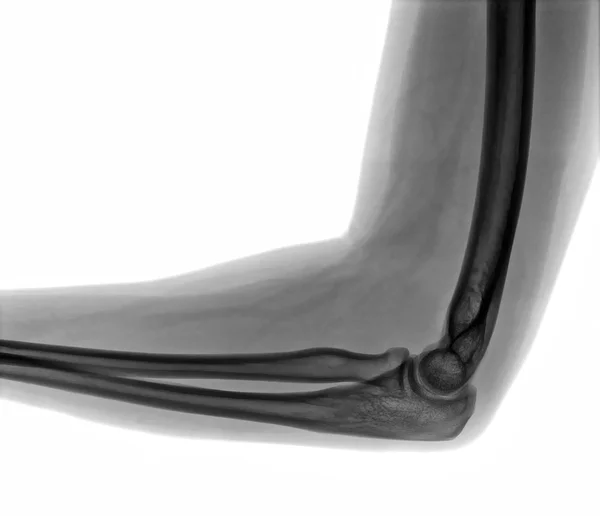 Armbågs röntgen Visa — Stockfoto