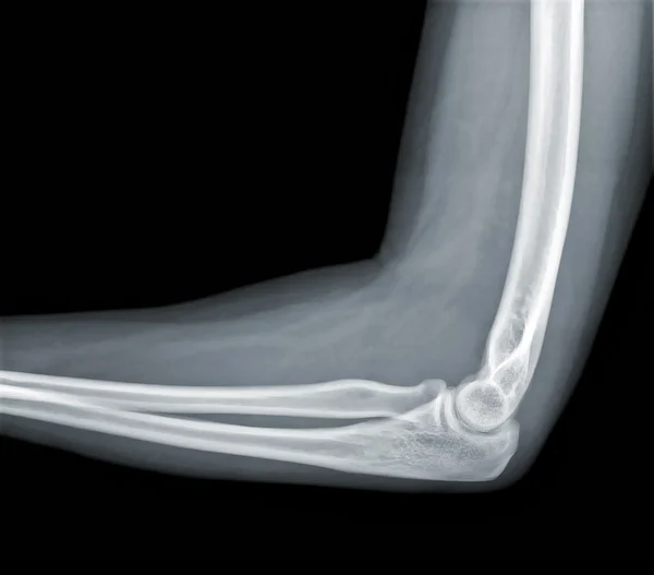 Röntgen Visa av armbågar — Stockfoto