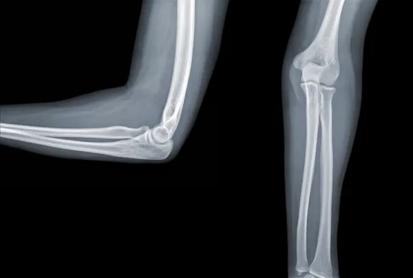 X-ray elleboog — Stockfoto