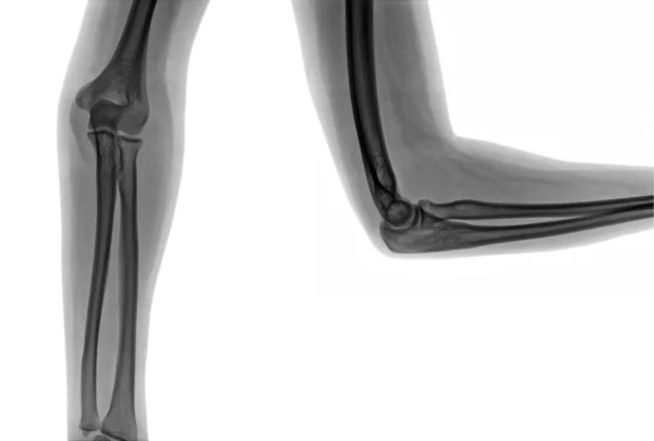 X-ray elleboog — Stockfoto