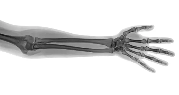 Hand röntgen — Stockfoto