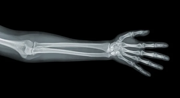 Hand x-ray weergave — Stockfoto