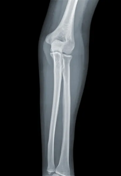 Koleno x-ray negativní — Stock fotografie
