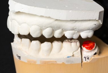 Mold of teeth taken for orthodontics clipart