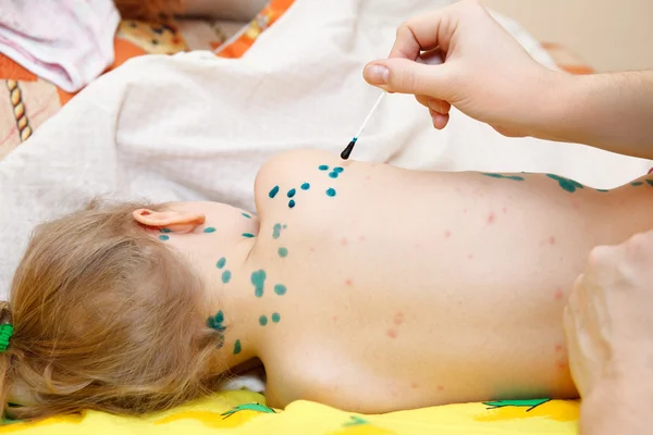 Petit enfant atteint de varicelle zoster. Thérapie de la peinture verte ou d'un colorant vert brillant . — Photo