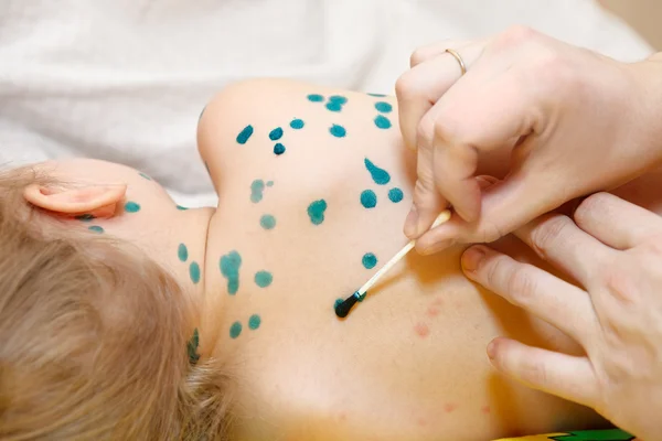 Malé dítě neštovice zoster virus onemocnění. terapie zelené barvy nebo brilantní zelené barvivo. — Stock fotografie