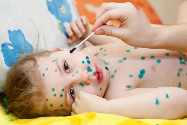 Małe dziecko z varicella zoster wirus choroby. Terapia zielonej farby lub jasny zielony barwnik. — Zdjęcie stockowe