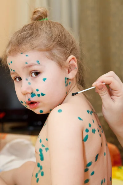 Kleines Kind mit Varizella-Zoster-Virus-Erkrankung. Therapie mit grüner Farbe oder leuchtend grünem Farbstoff. — Stockfoto