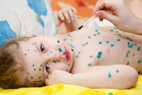 Kleines Kind mit Varizella-Zoster-Virus-Erkrankung. Therapie mit grüner Farbe oder leuchtend grünem Farbstoff. — Stockfoto