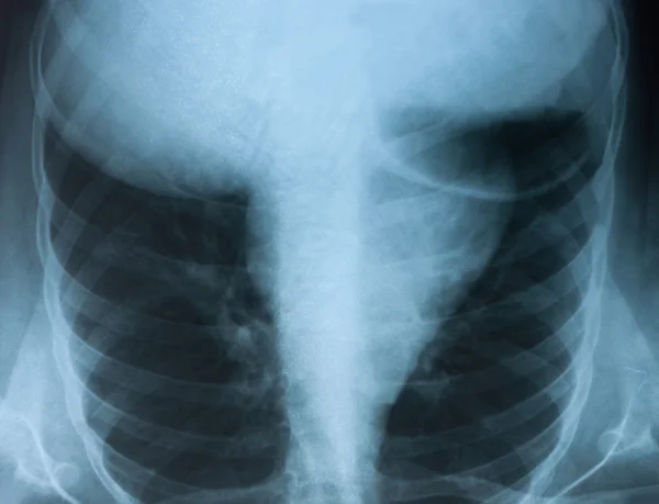 Medyczne Zdjęcie rentgenowskie klatki piersiowej. — Zdjęcie stockowe