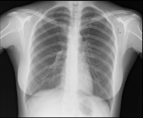 Una imagen de rayos X de tórax — Foto de Stock