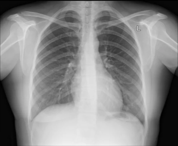 Una imagen de rayos X de tórax — Foto de Stock