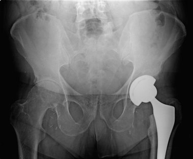 Hip Prosthesis MR, artificial device used to replace a missing b clipart