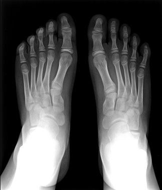 Foot fingers exposed on x-ray black and white film, MRI clipart