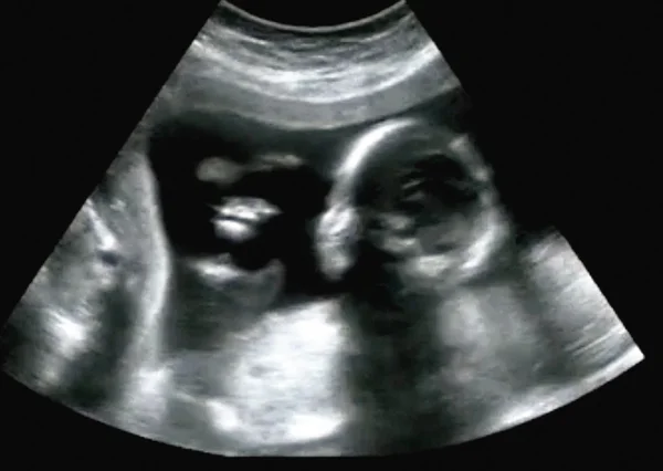 最初の月の産科超音波検査超音波診断法 — ストック写真