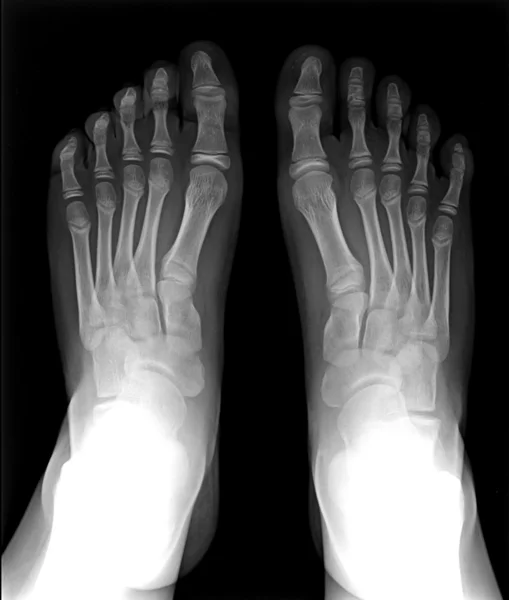 Voet vingers blootgesteld op x-ray zwart en wit film, mri — Stockfoto