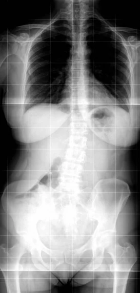 Ressonância magnética da coluna vertebral. Ressonância magnética vista frontal — Fotografia de Stock
