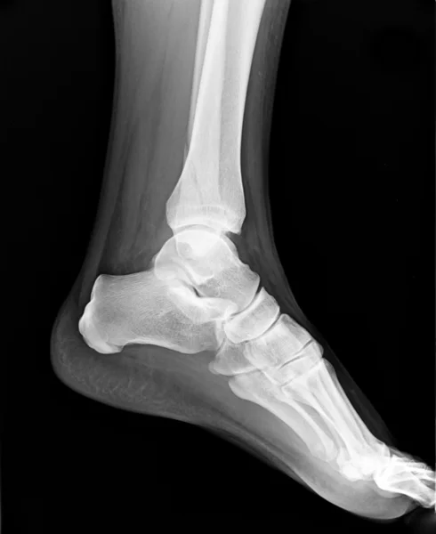RMN del pie izquierdo con dedos de los pies - Radiografía — Foto de Stock