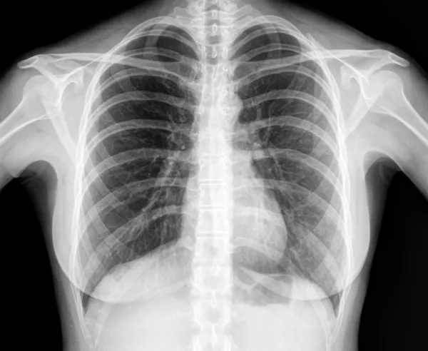 人类健康胸部的X射线图像 — 图库照片