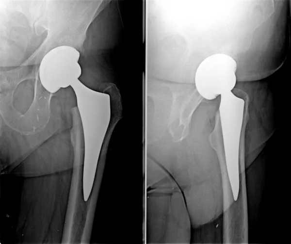 Röntgenaufnahme der Operation der Implantation einer Prothese in der — Stockfoto