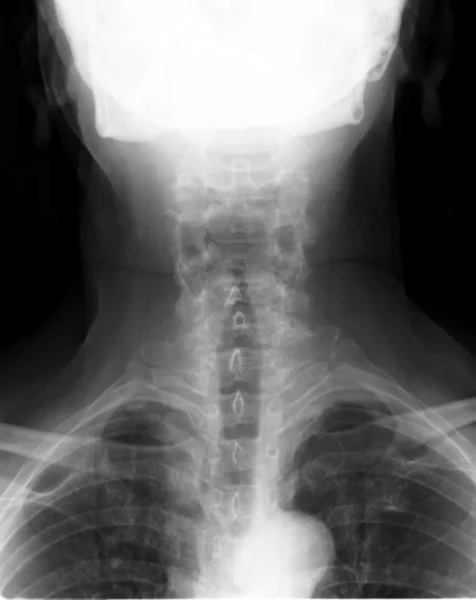 Wirbelsäule Rücken oberer Teil Röntgen — Stockfoto