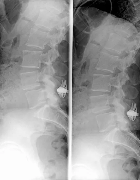 Lumbosakrala kolumn MRT - röntgen. vanlig film — Stockfoto