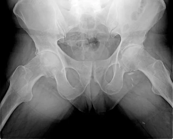 Regelmäßige Hüfte eines jungen Mannes auf dem Röntgenbild, isoliert auf schwarzem Hintergrund — Stockfoto