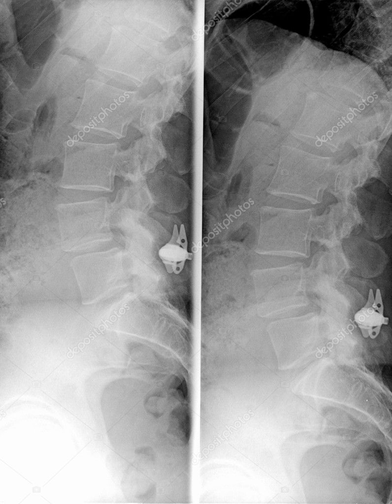 Lumbosacral column MRi - X-ray. plain film