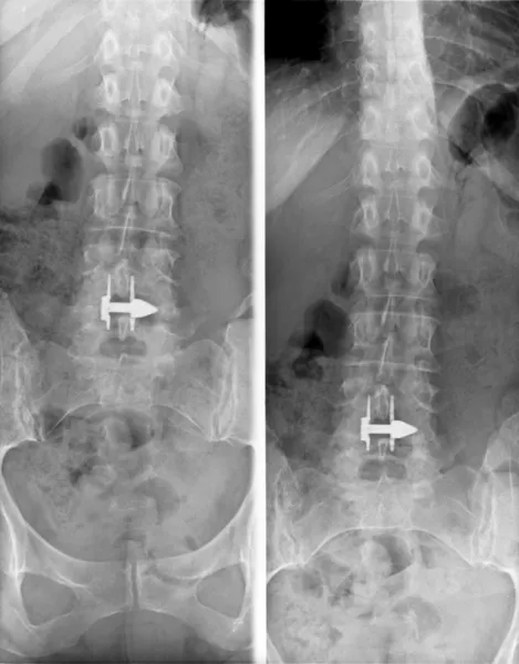 Lumbosacral column MRi - X-ray. plain film — Stock Photo, Image