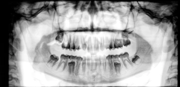 Panoramische tandheelkundige röntgenfoto — Stockfoto