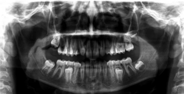Radiografía dental panorámica — Foto de Stock