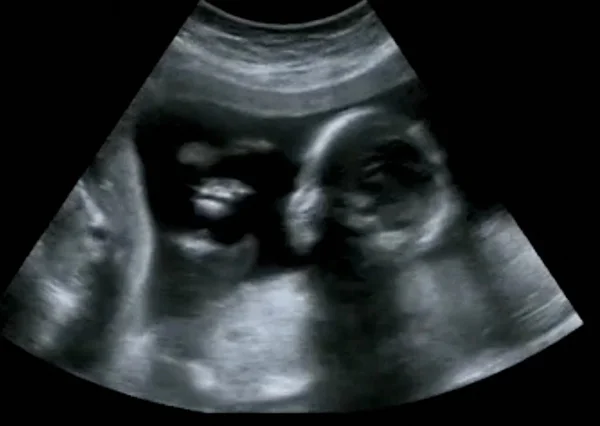 Obstetrische Ultrasonografie echografie echografie van een eerste maand — Stockfoto