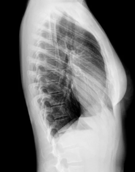 Rayon X de la colonne vertébrale - Vue latérale — Photo