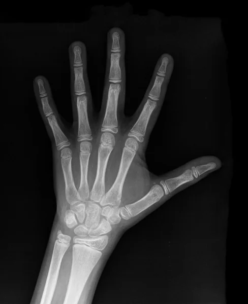 Punho esquerdo no raio-x filme negativo — Fotografia de Stock
