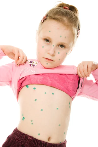 Little child with Varicella zoster — Stock Photo, Image