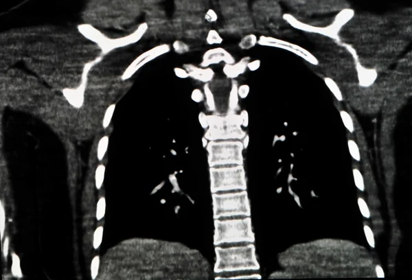 肺 ct — ストック写真