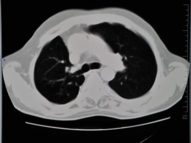 Lung ct clipart