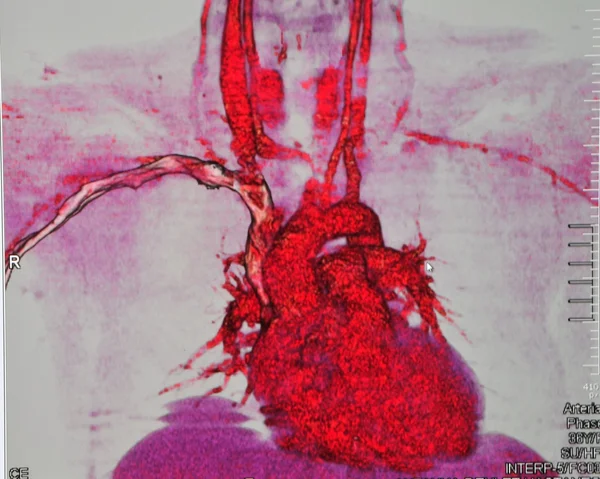 관상 동맥 혈관 — 스톡 사진