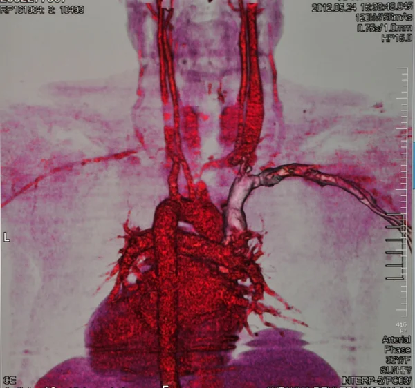 Angiografia coronarica — Foto Stock