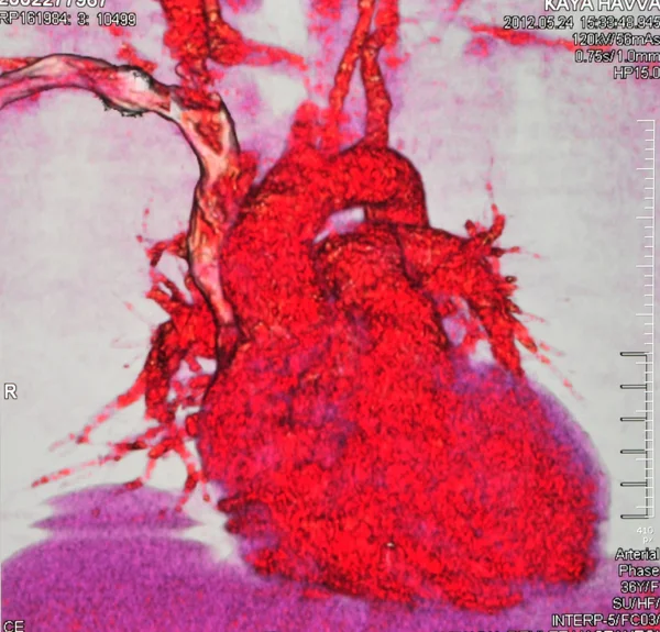 Angiografía coronaria — Foto de Stock