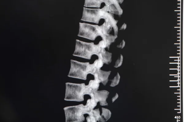 Fracture — Stock Photo, Image