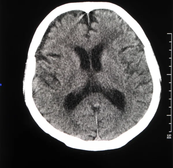 CT mozku — Stock fotografie
