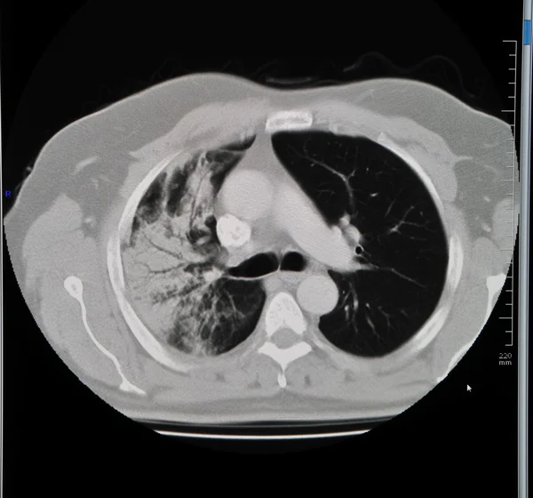 Lung ct — Stock Photo, Image